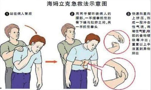 成人吞东西急救方法视频,视频教程详解