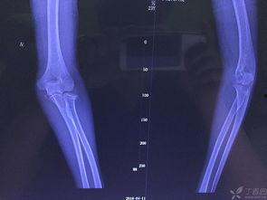 成人骨折宣传视频大全,成人骨折宣传视频精选集锦